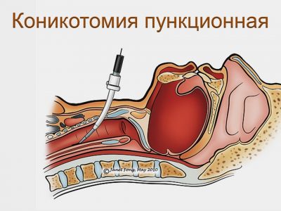 Причины стеноза гортани у детей, характерная симптоматика и методы терапии