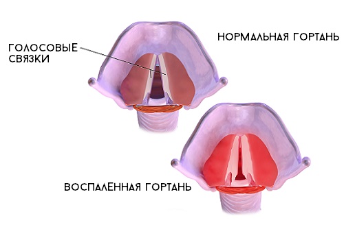 Отсутствие лечения может привести к строму воспалению гортани