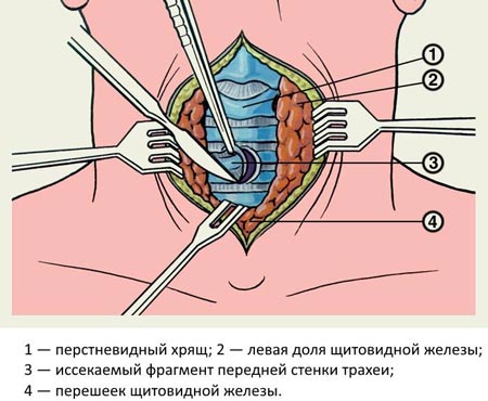 Причины стеноза гортани у детей, характерная симптоматика и методы терапии