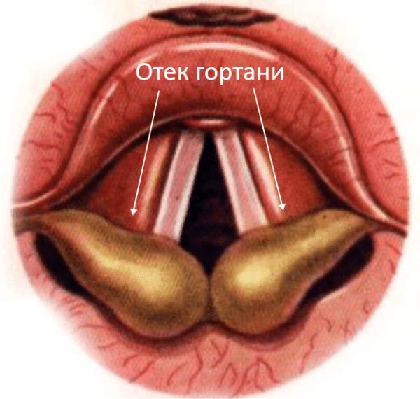 Причины, симптомы и методы лечения отека гортани у взрослых, оказание первой помощи