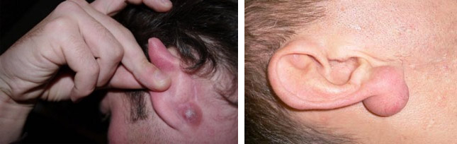 Причины появления жировика за ухом