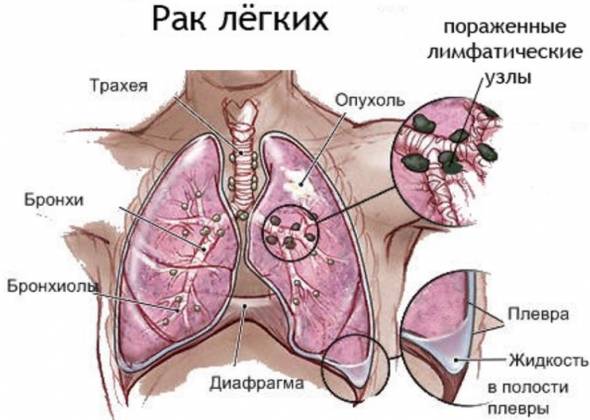 Мокрота курильщика и после отказа от курения. Сколько отходит и как избавиться