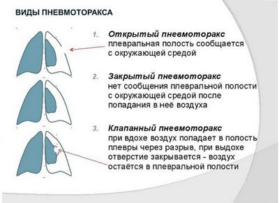 Пневмоторакс легкого