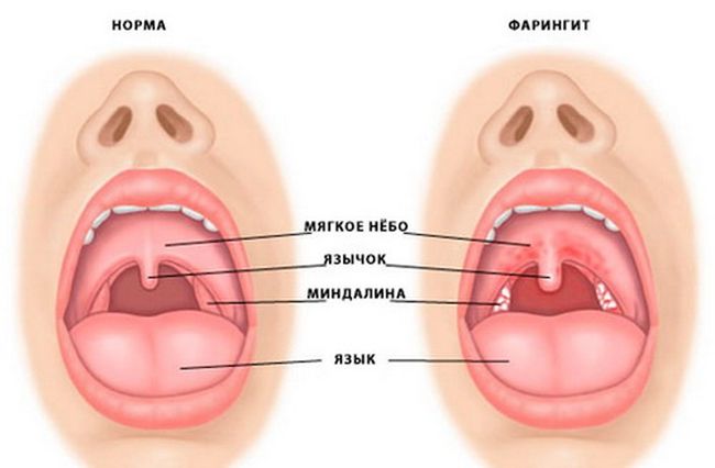 Как лечить фарингит у детей в домашних условиях быстро и эффективно