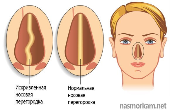 Кривой нос - способы исправить дефект