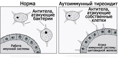 Причины болей кадыка при глотании