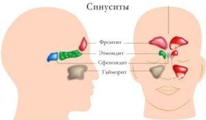 Симптомы и лечение двустороннего синусита