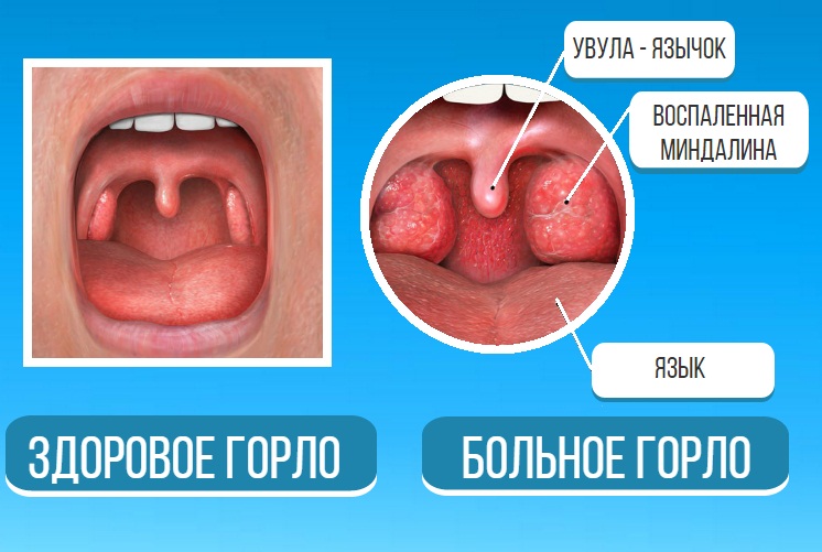 Опухлость и воспаление язычка в горле причины и лечение