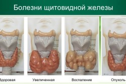 Пальпация гортани и шеи