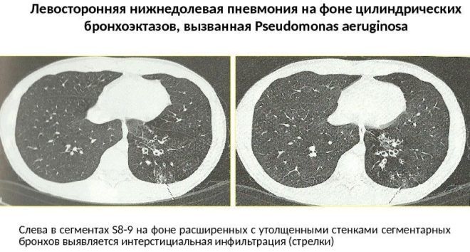 Левосторонняя бронхопневмония