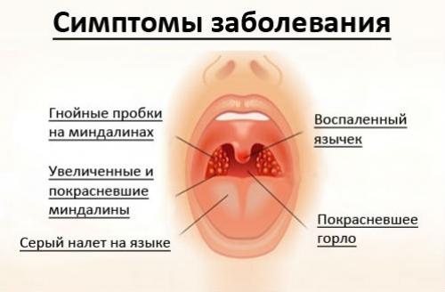 Причины, симптомы и методы лечения отека гортани у взрослых, оказание первой помощи