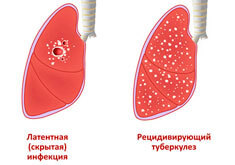 Сильный кашель ночью