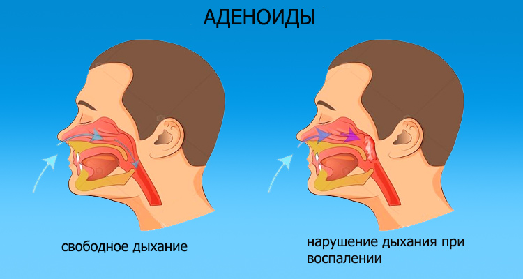 Заложена одна ноздря соплей нет
