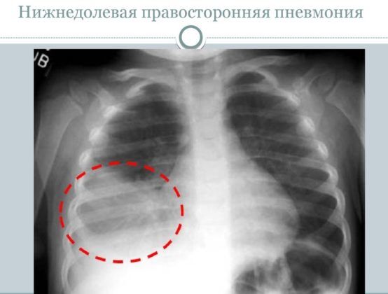 Особенности бронхиальной пневмонии у детей