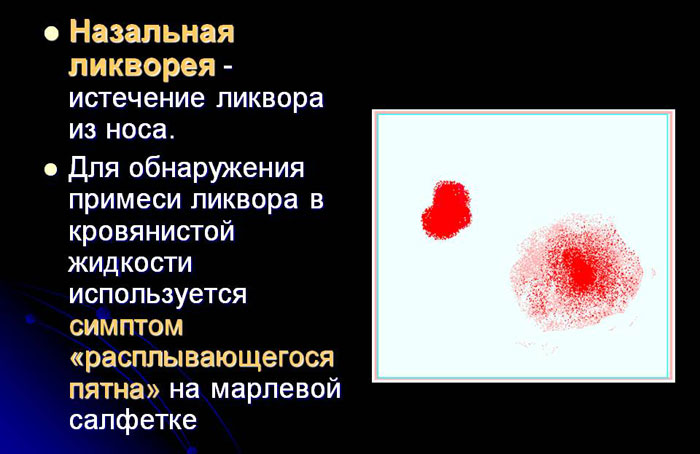 Нетрадиционные способы лечения назальной ликвореи