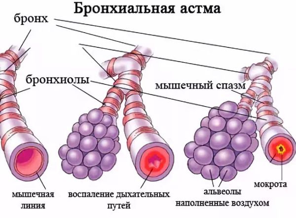 Помогает ли Флуимуцил от кашля