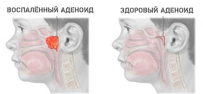 Почему закладывает нос без насморка ночью