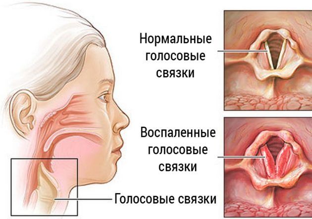 Жжение в гортани, в чём кроется причина