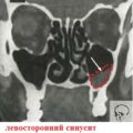 Обследование околоносовых пазух при помощи компьютерной томографии