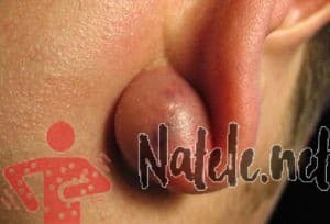 Шарик или шишка в мочке уха