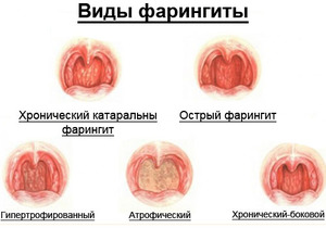Заболевания горла и гортани симптомы и лечение болезни