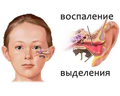 Как избавиться от насморка у малыша: основные моменты