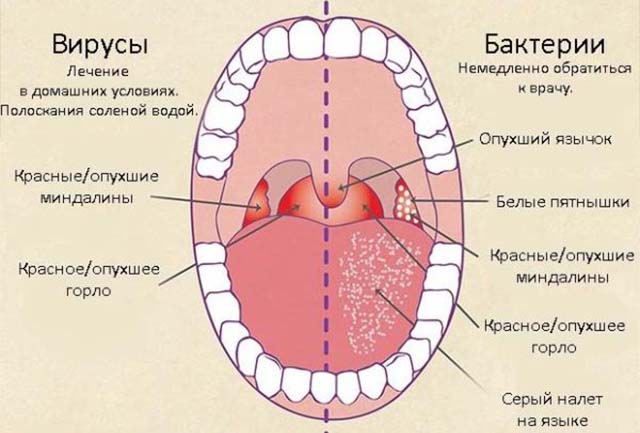 Симптомы, лечение и причины отека гортани у взрослых, оказание первой помощи
