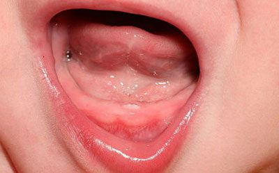 Сопли при прорезывании зубов и появление насморка