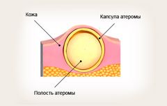Шарик или шишка в мочке уха