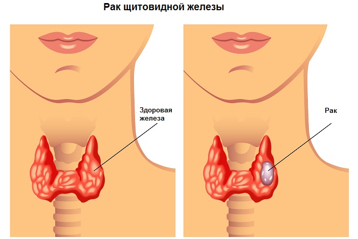 Причины болей кадыка при глотании