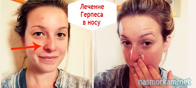 Какую использовать мазь для профилактики простуды