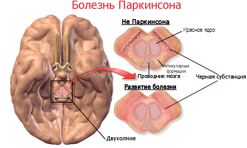Головной мозг при болезни Паркинсона Рисунок, отражающий изменения в головном мозге человека при болезни Паркинсона