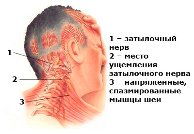 Невралгия затылочного нерва Защемление затылочного нерва