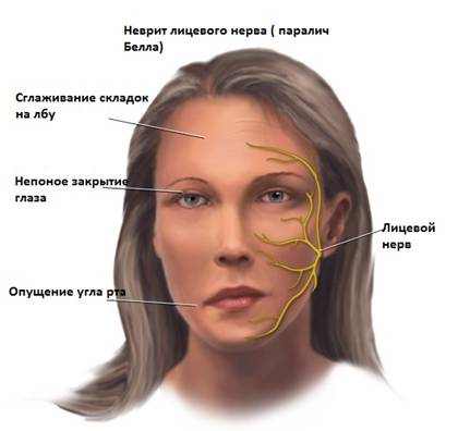 Неврит Симптомы неврита лицевого нерва