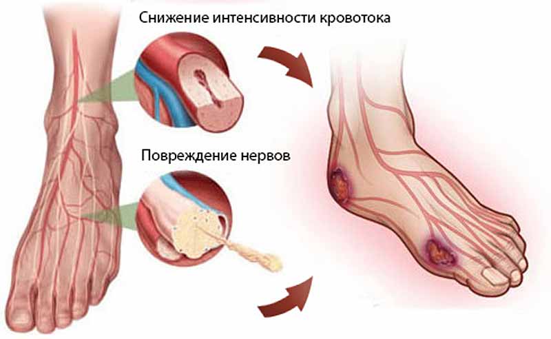 полинейропатия Полинейропатия нижних конечностей