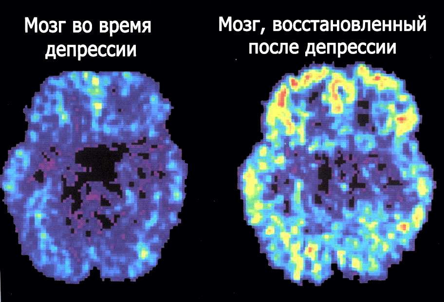 Снимок мозга Снимок головного мозга во время депрессии и в восстановленном состоянии
