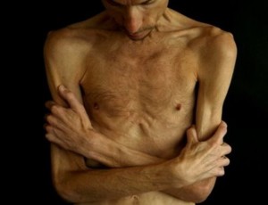 Анорексик