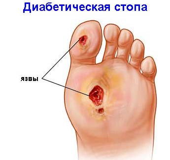 Диабетическая стопа Язвы на стопе при диабетической нейропатии