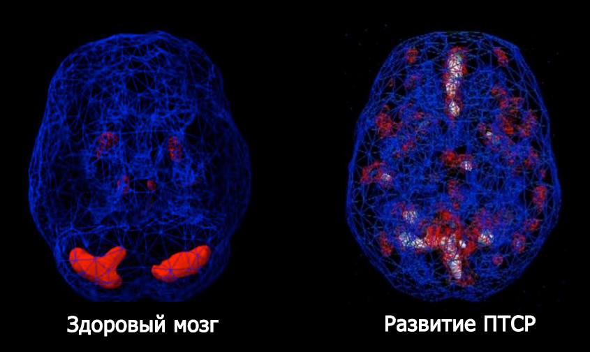 Снимок головного мозга человека Снимок демонстрирует изменения в головном мозге человека при посттравматическом стрессовом расстройстве