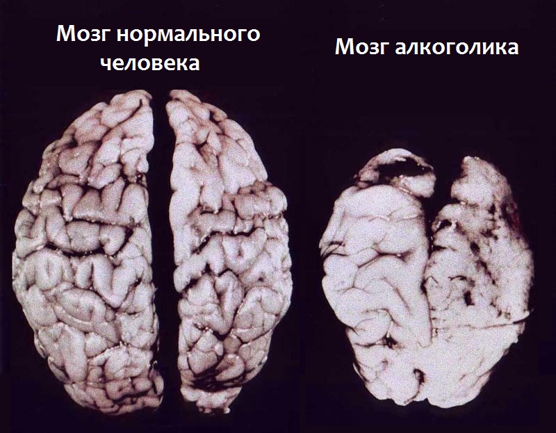 Мозг алкоголика Фото человеческого мозга после вскрытия. Слева - здорового человека, справа - злоупотреблявшего алкоголем.
