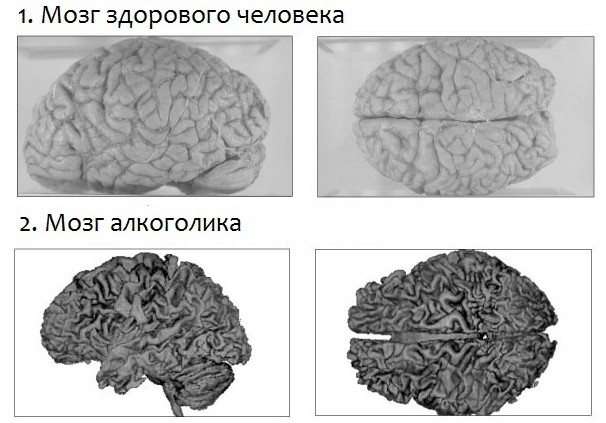 мозг человека Влияние алкоголя на мозг человека.