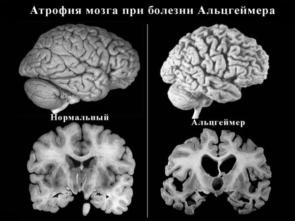 МРТ головного мозга Атрофия мозга при болезни Альцгеймера