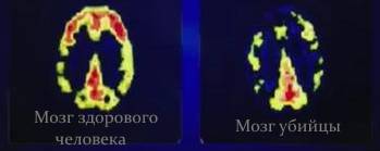 МРТ головного мозга МРТ сравнение головоногого мозга здорового человека и убийцы