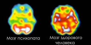 МРТ головного мозга МРТ головного мозга здорового человека и психопата