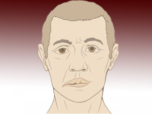 парез лицевого нерва, симптомы