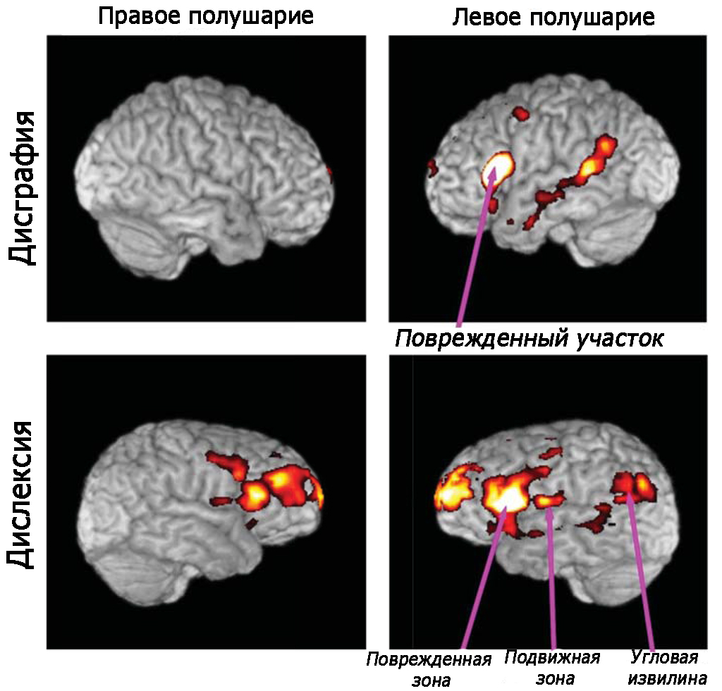 Снимок мозга Пораженные участки мозга при дисграфии и дислексии