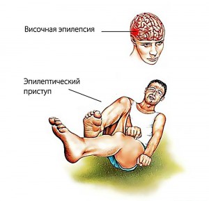 височная эпилепсия